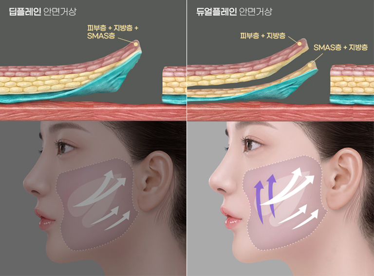 허쉬 듀얼플레인 안면거상의 핵심